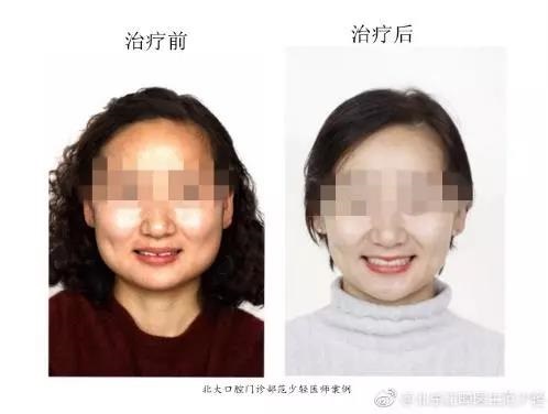 北大口腔范少轻医生牙齿矫正案例
