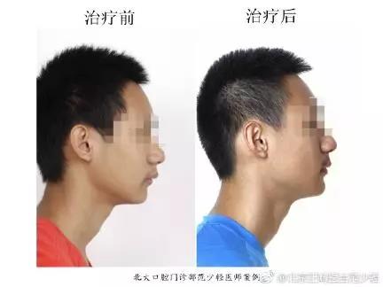 北大口腔范少轻医生牙齿矫正案例
