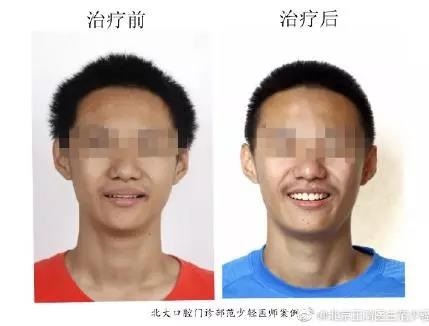 北大口腔范少轻医生牙齿矫正案例