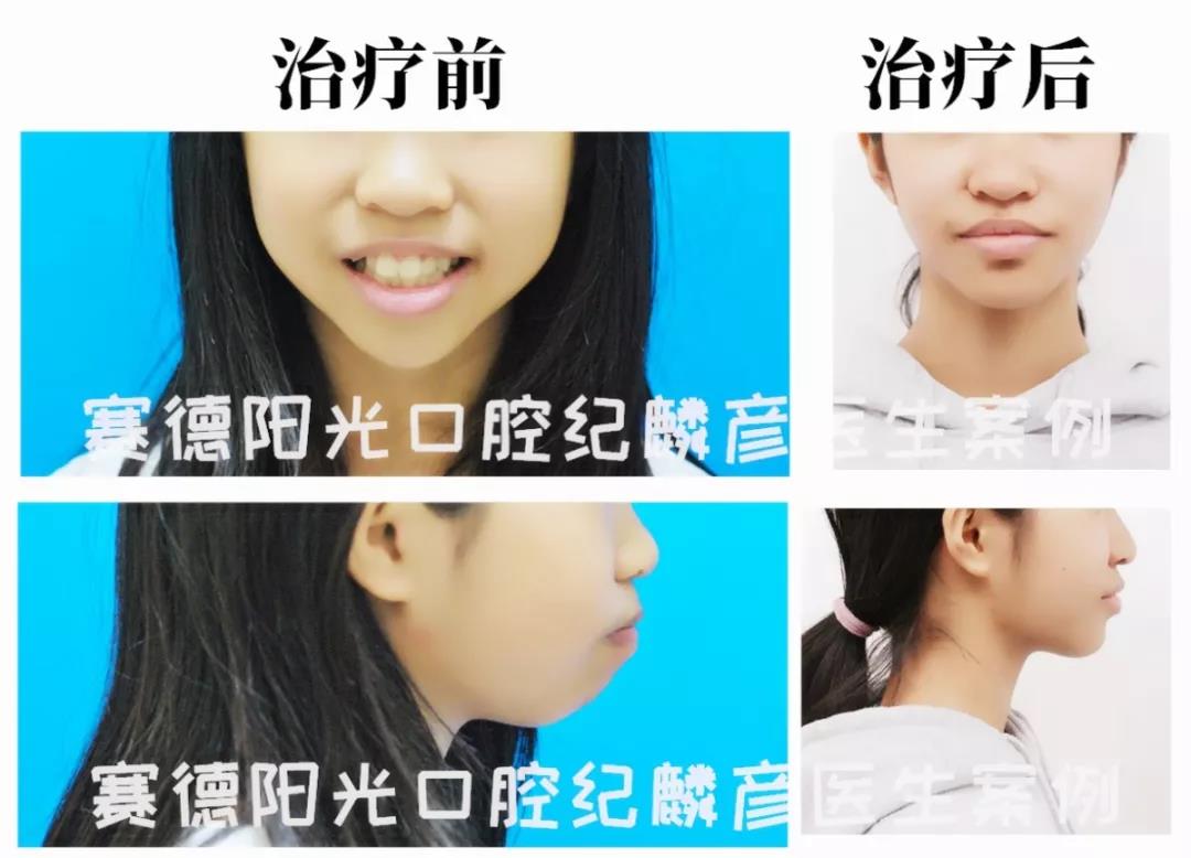 纪麟彦医生正畸案例