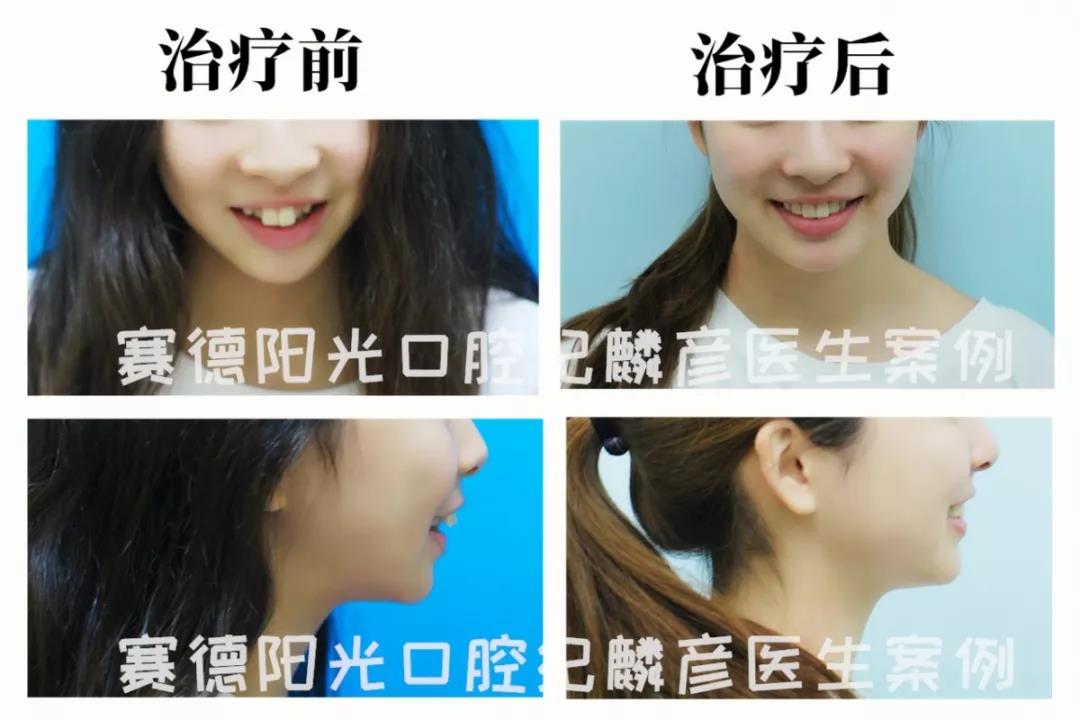 纪麟彦医生正畸案例
