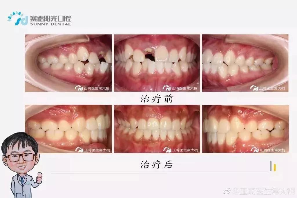 常大桐医生正畸案例
