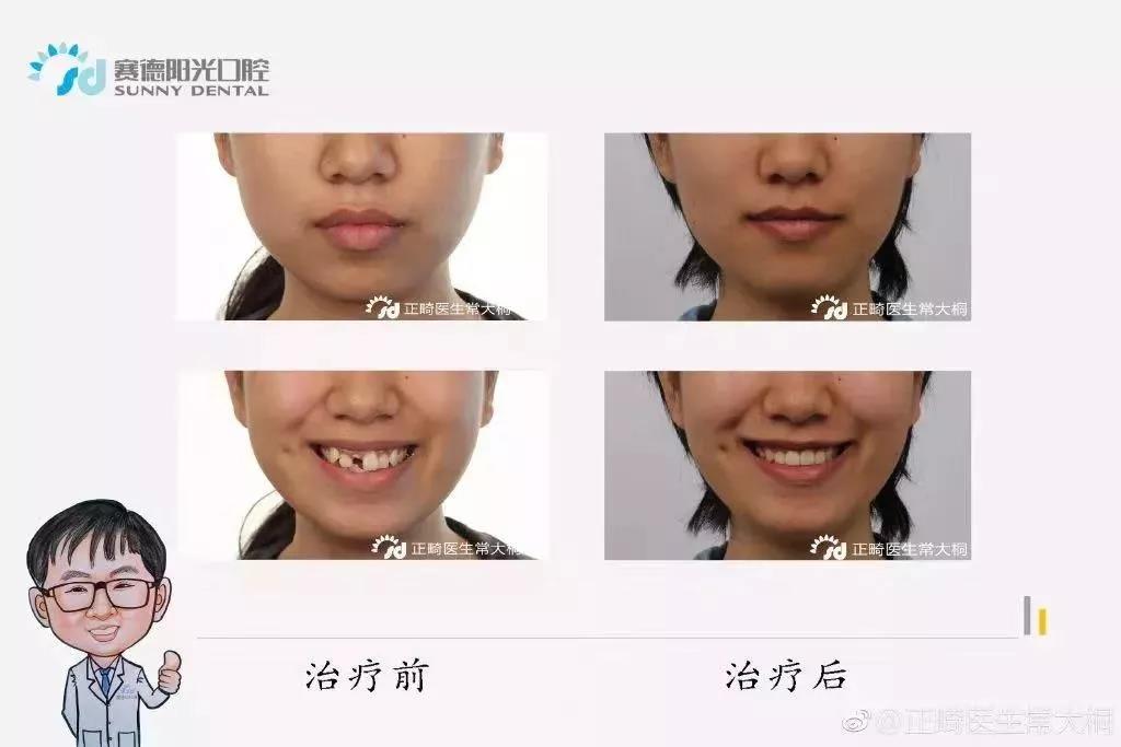 常大桐医生正畸案例