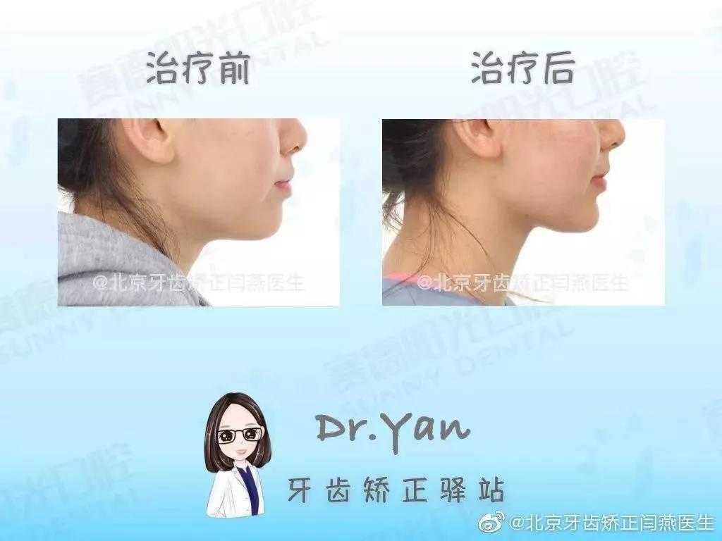 闫燕医生正畸案例