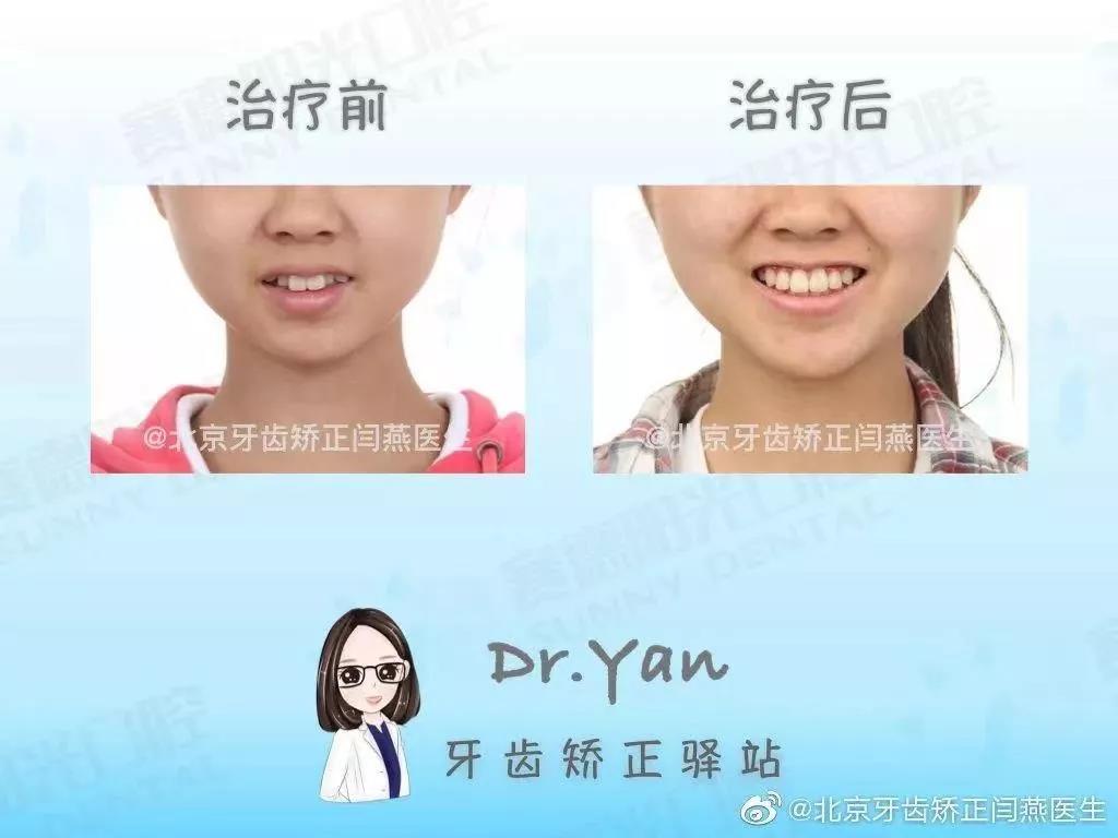 闫燕医生正畸案例