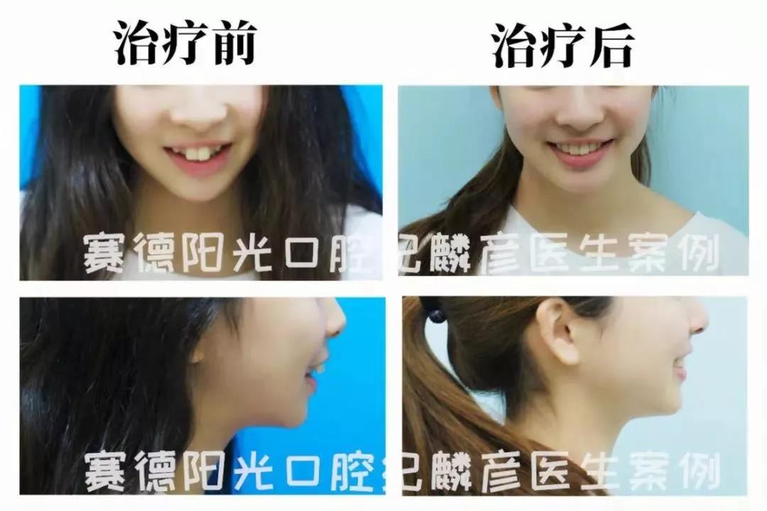 纪麟彦医生正畸案例