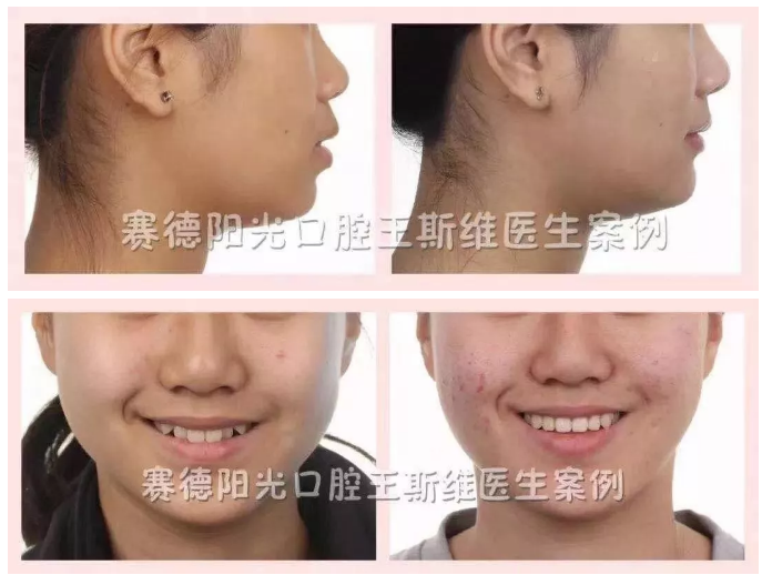 王斯维医生正畸案例
