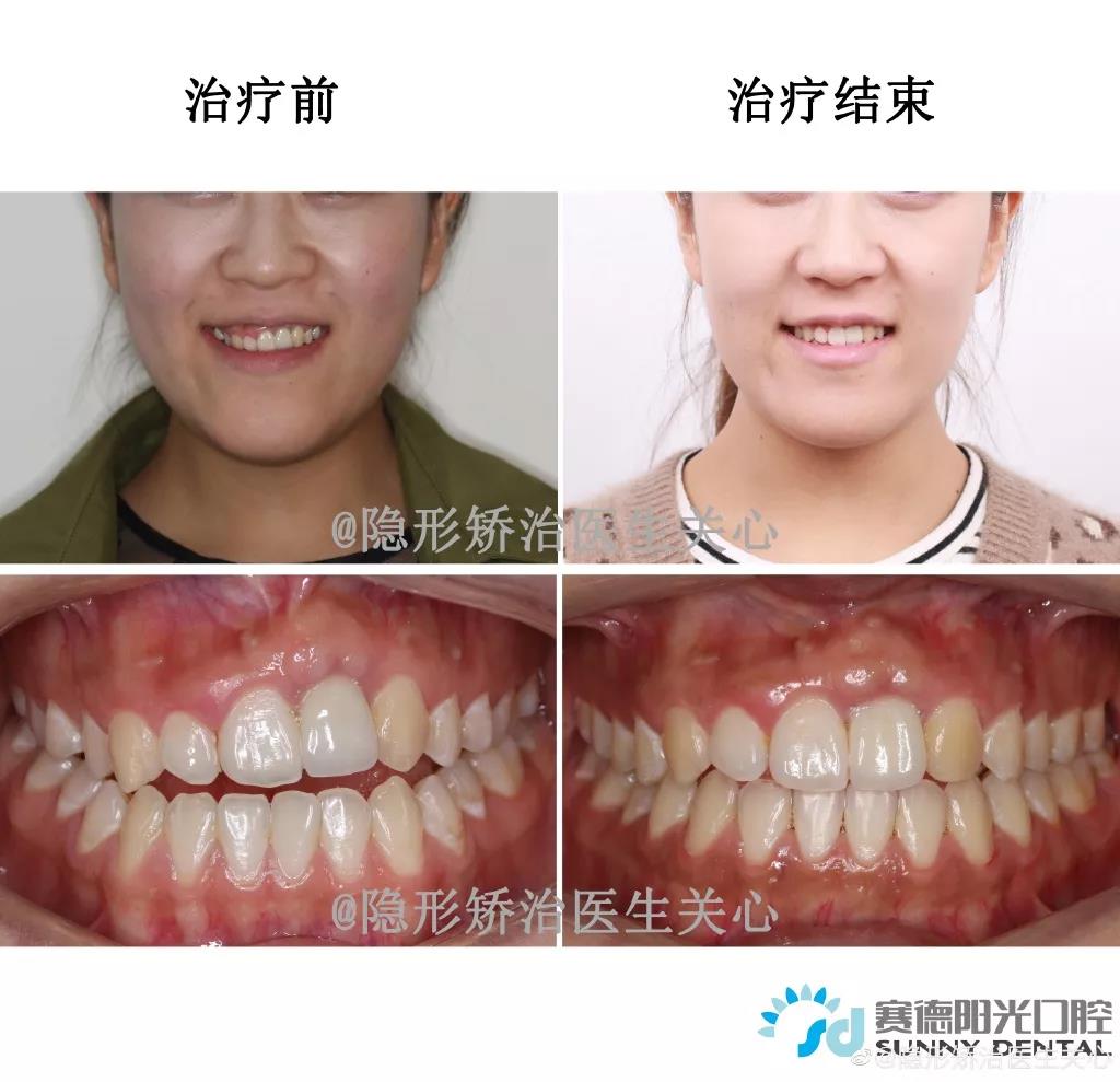 隐适美关心医生隐形矫治案例