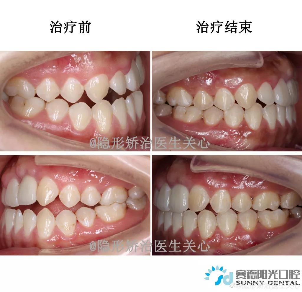 隐适美关心医生隐形矫治案例