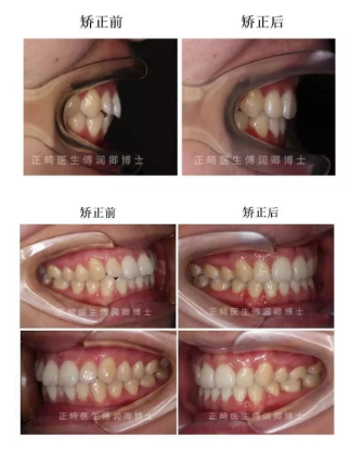 傅润卿博士的牙齿矫正案例