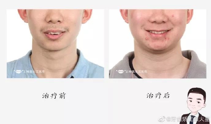 王高南医生正畸案例