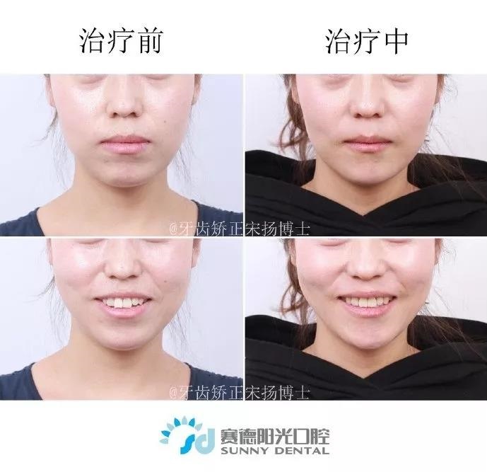宋扬医生正畸案例