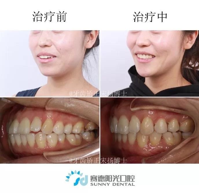 宋扬医生正畸案例