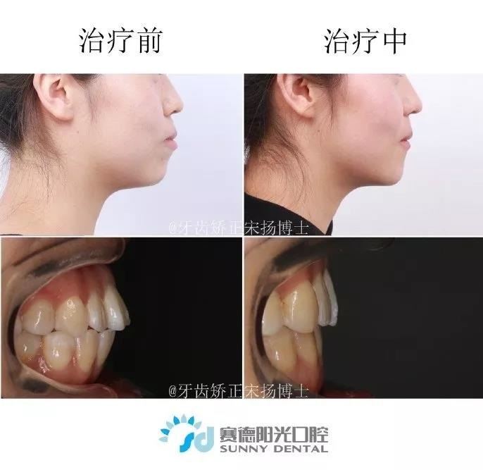 宋扬医生正畸案例