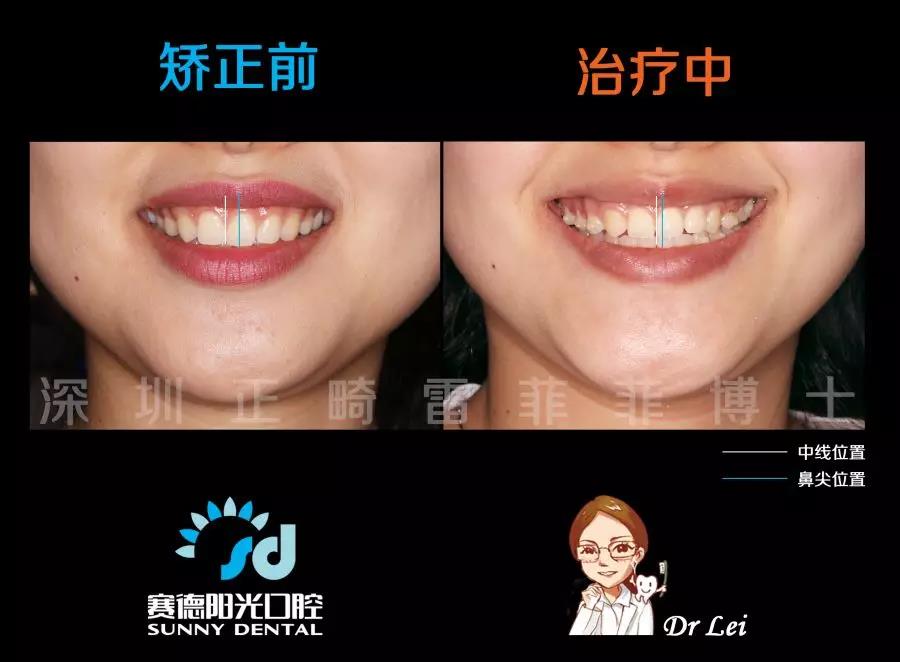 矫正中对比照片