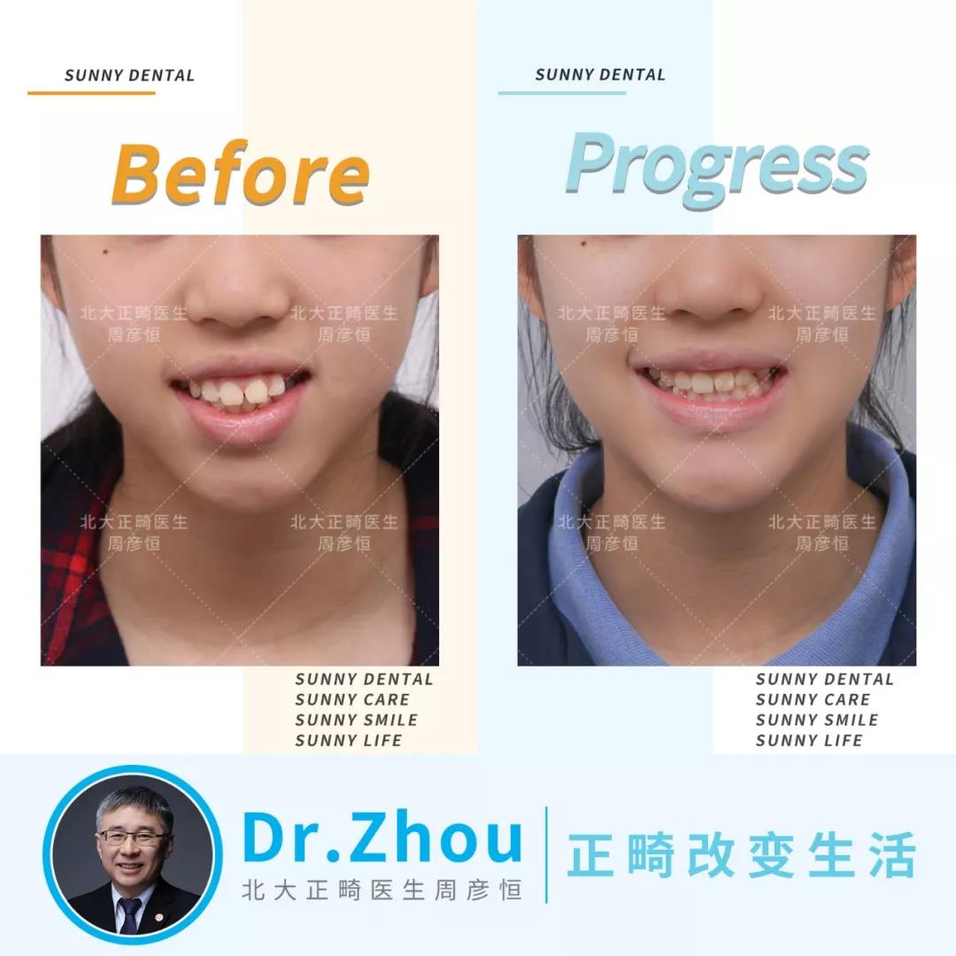 周彦恒教授青少年牙齿矫正隐适美矫正案例