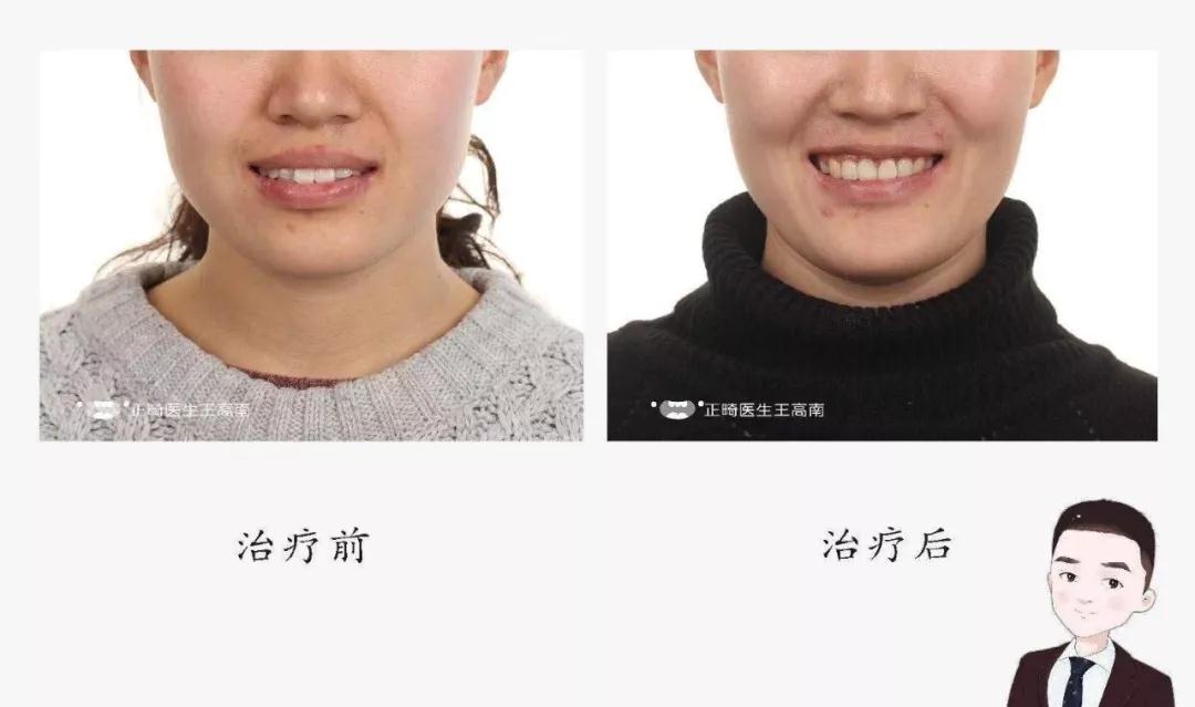 王高南医生正畸案例
