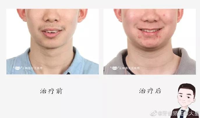 王高南医生正畸案例
