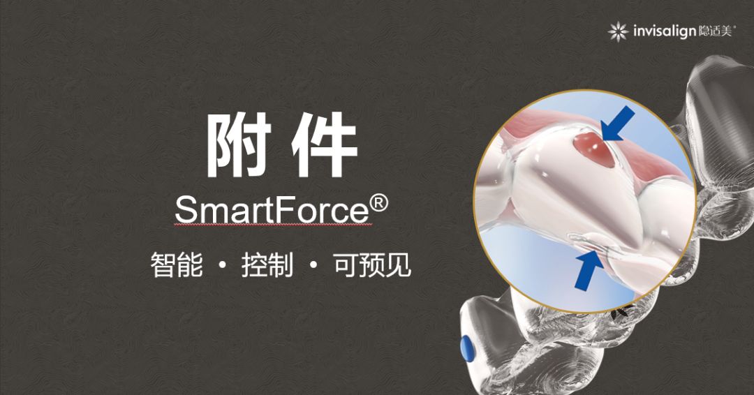 隐适美新品Moderate中度套装