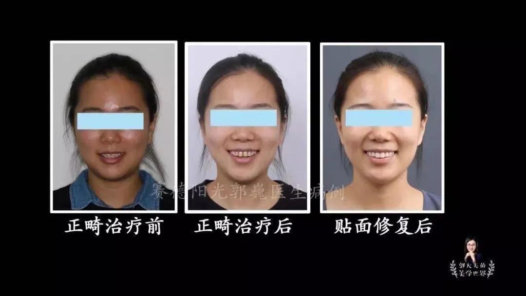 郭巍医生正畸与修复案例