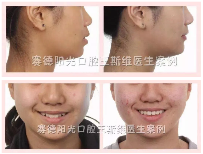王斯维医生正畸案例