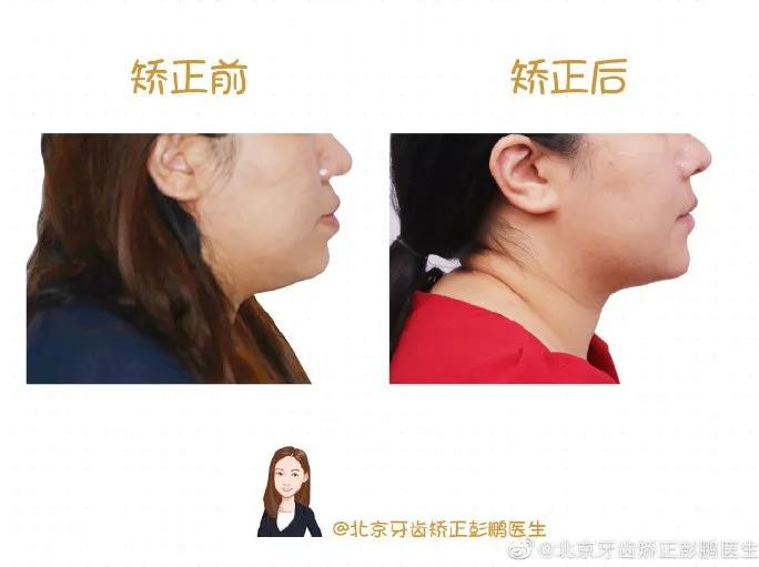 彭鹏医生正畸案例一