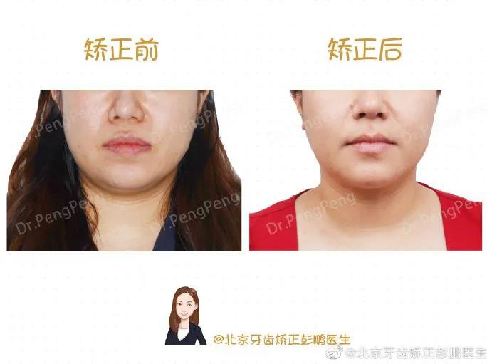 彭鹏医生正畸案例一
