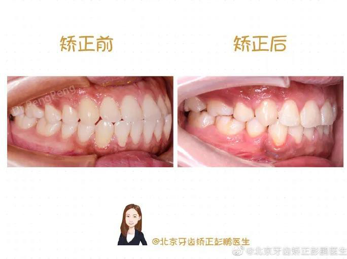 彭鹏医生正畸案例一