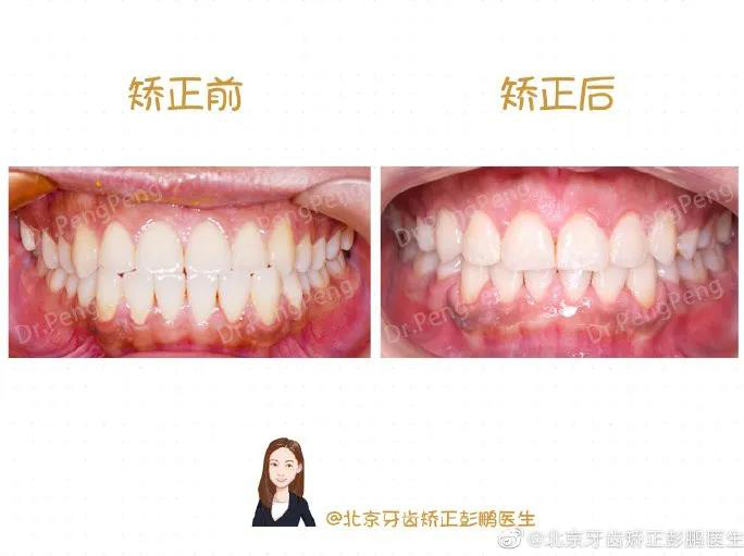 彭鹏医生正畸案例一