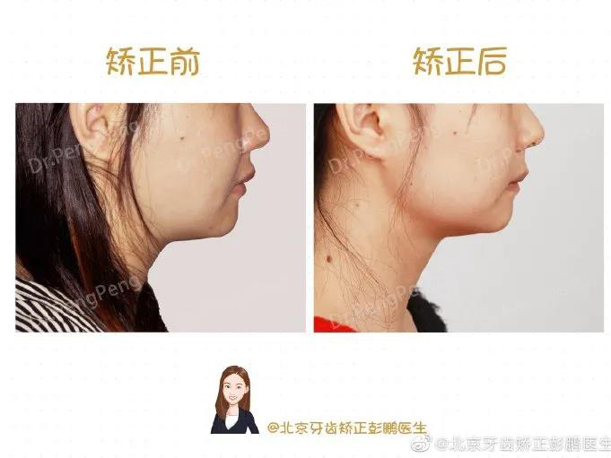 彭鹏医生正畸案例一