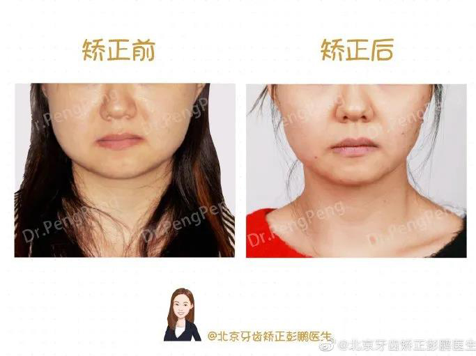 彭鹏医生正畸案例一