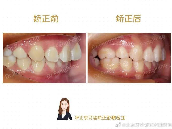 彭鹏医生正畸案例一