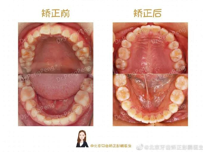 彭鹏医生正畸案例一