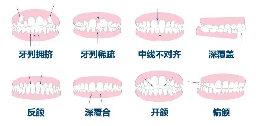 常见的牙齿畸形
