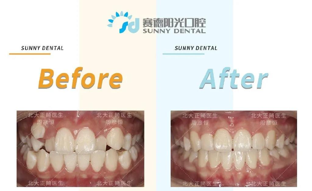 赛德阳光口腔正畸案例