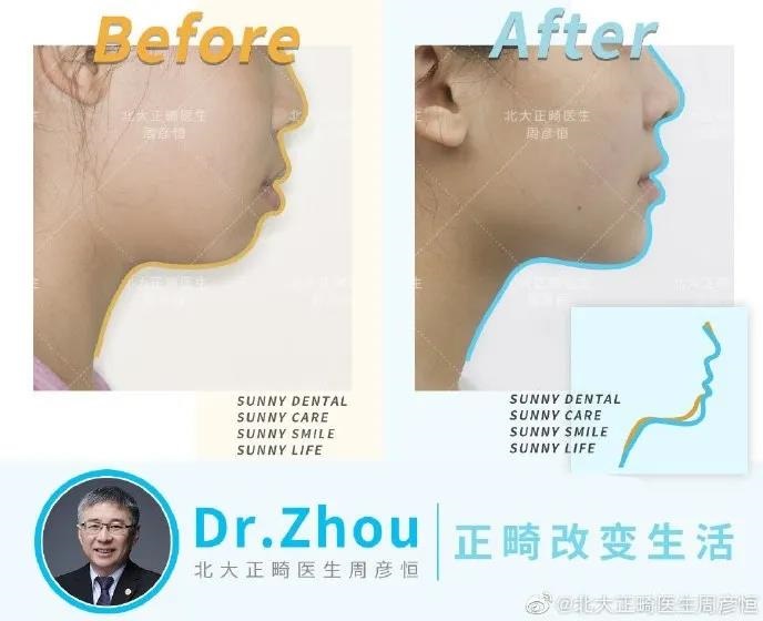 赛德阳光口腔正畸案例