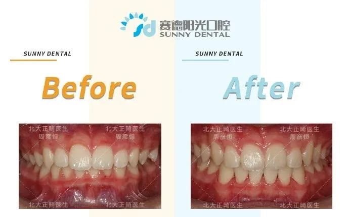 赛德阳光口腔深覆合正畸案例
