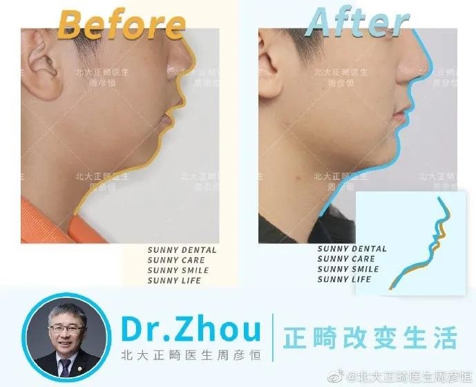 赛德阳光口腔深覆合正畸案例