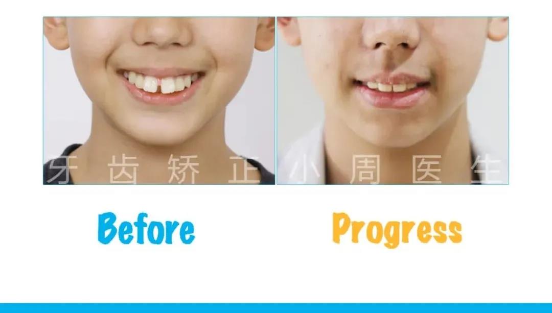 赛德阳光口腔深覆盖正畸案例