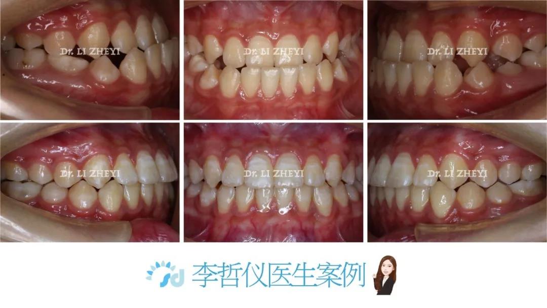 赛德阳光口腔反颌正畸案例