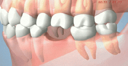 原本健康的牙齿也会被牵连，更容易松动，脱落的风险增高。