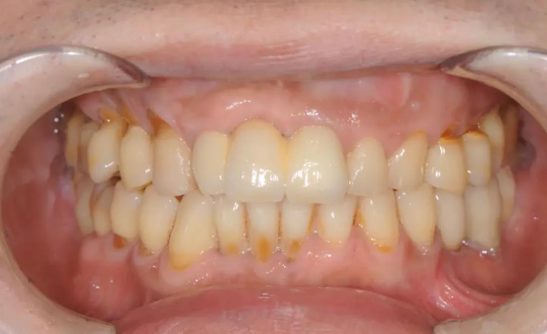 上下颌多颗牙齿出现楔状缺损 咬合关系需要调整