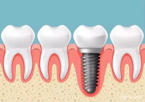 种植牙或种牙，常被人称为是人类的“第三副牙齿”：