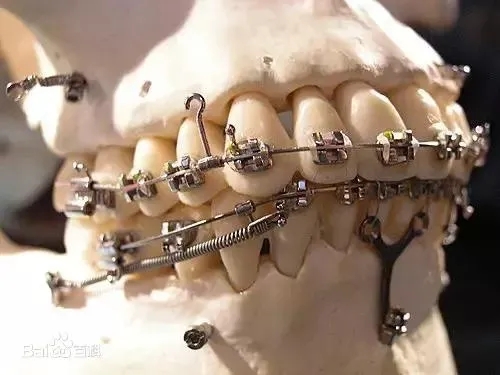 牙周病患者在正畸治疗后牙周组织明显改善