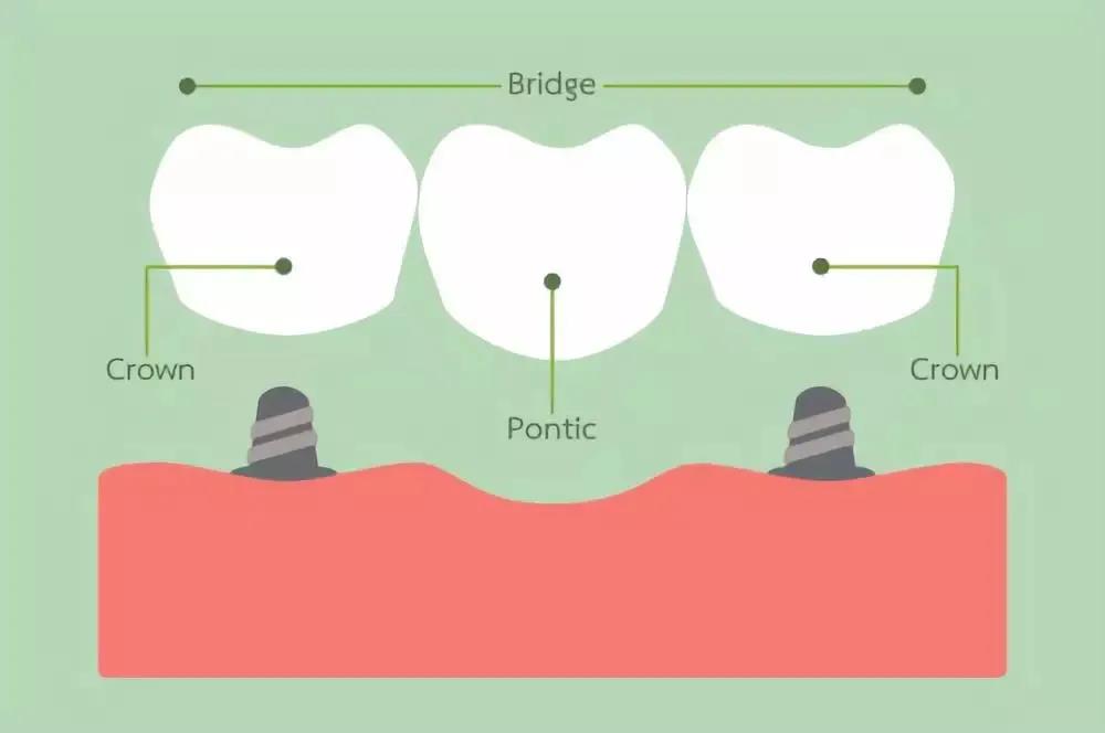 牙齿缺失或牙体缺损会导致的问题